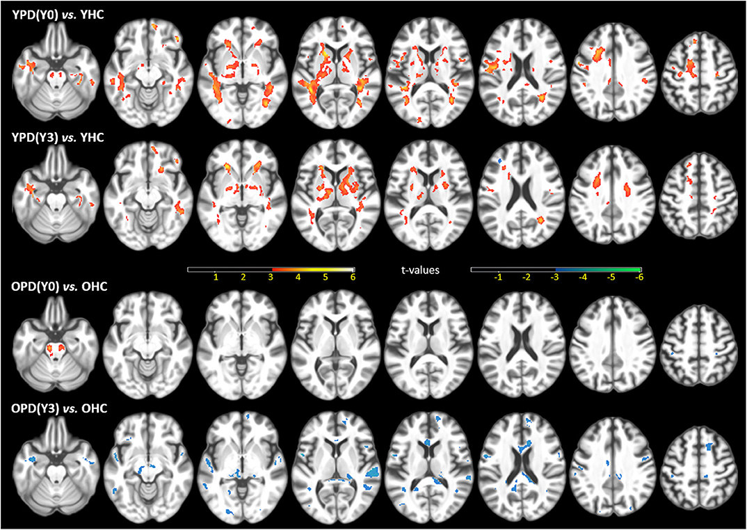 Motor Parkinson's disease and structure (Chapter 3) - Magnetic Resonance  Imaging in Movement Disorders