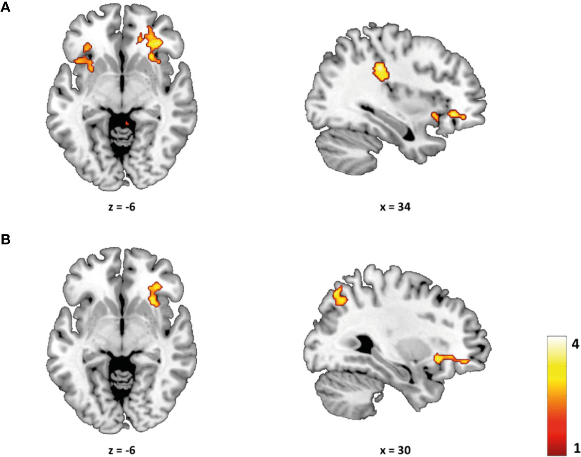 Subthalamic nucleus connectivity in binge drinkers and