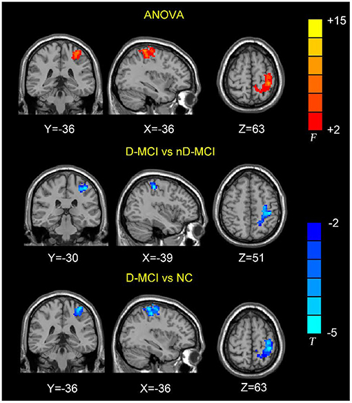 Frontiers  Neural activity in adults with major depressive disorder  differs from that in healthy individuals: A resting-state functional  magnetic resonance imaging study