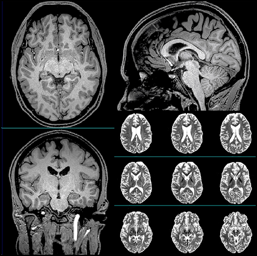 Brain stimulation may help TBI patients with memory recall