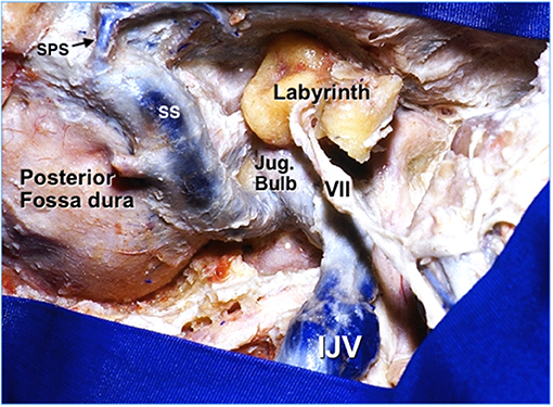 Frontiers | Microsurgical Anatomy of the Jugular Foramen Applied to
