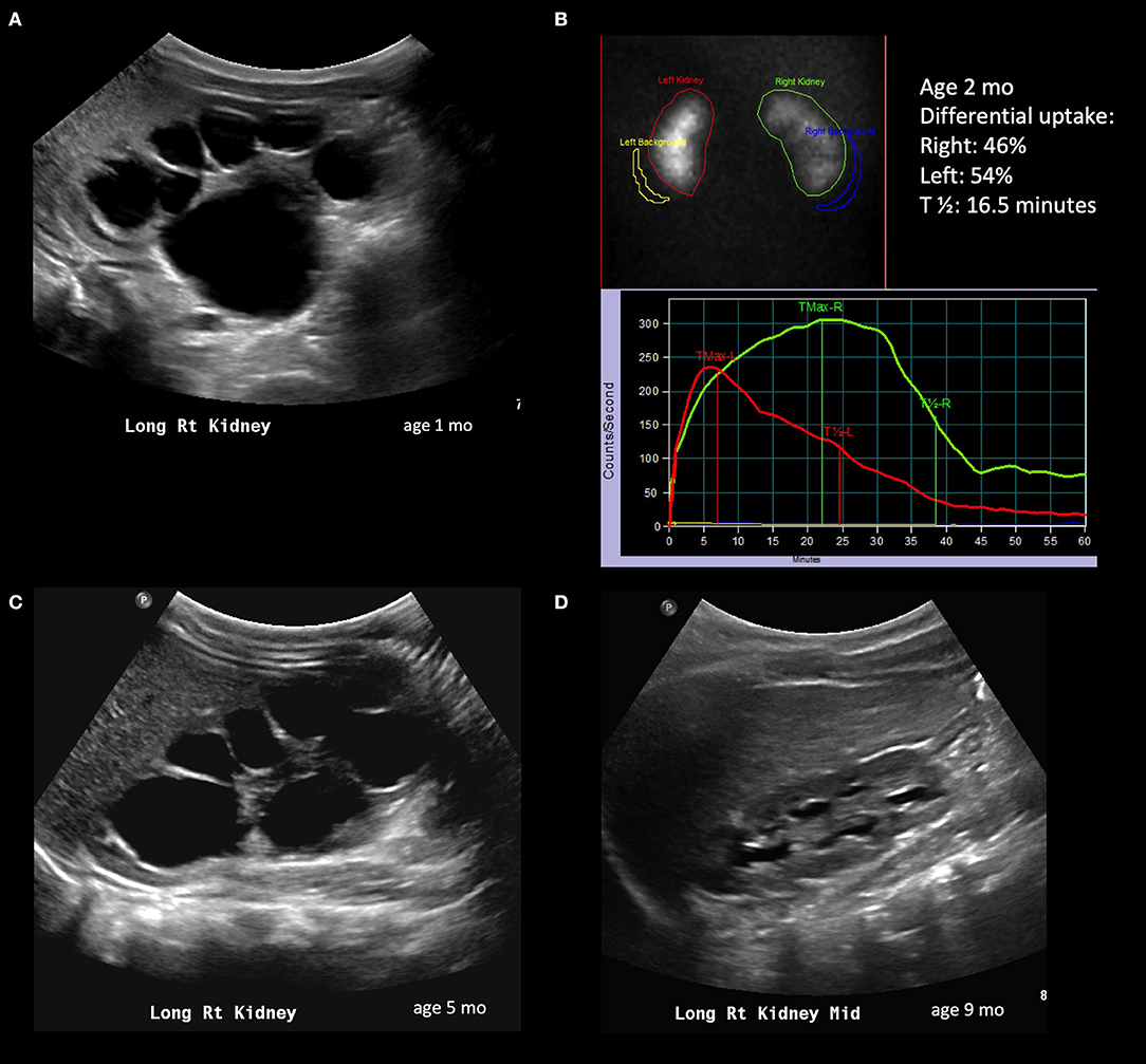Ureteropelvic Junction Obstruction Ultrasound