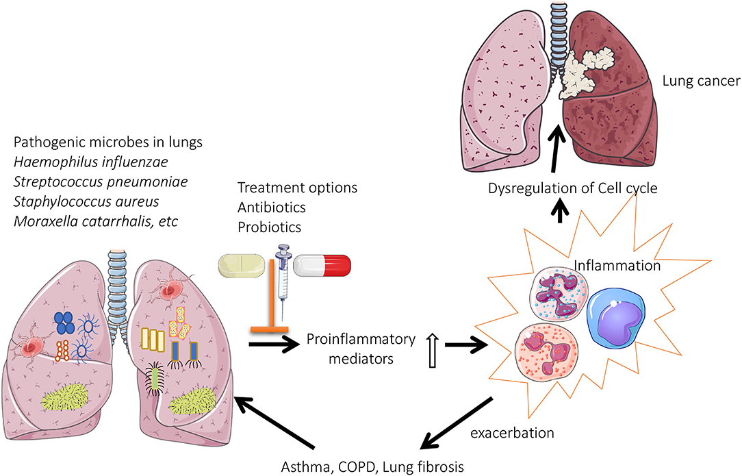 malignant mesothelioma metastasis