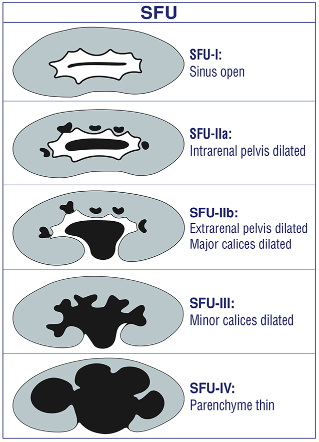 Frontiers Grading Of Hydronephrosis An Ongoing Challenge Pediatrics