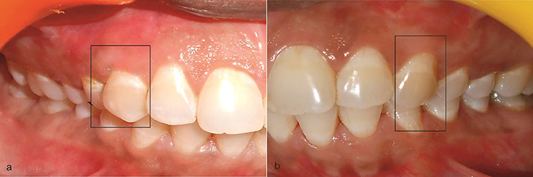 All About Gum and Jaw Recession - Dr Jamilian
