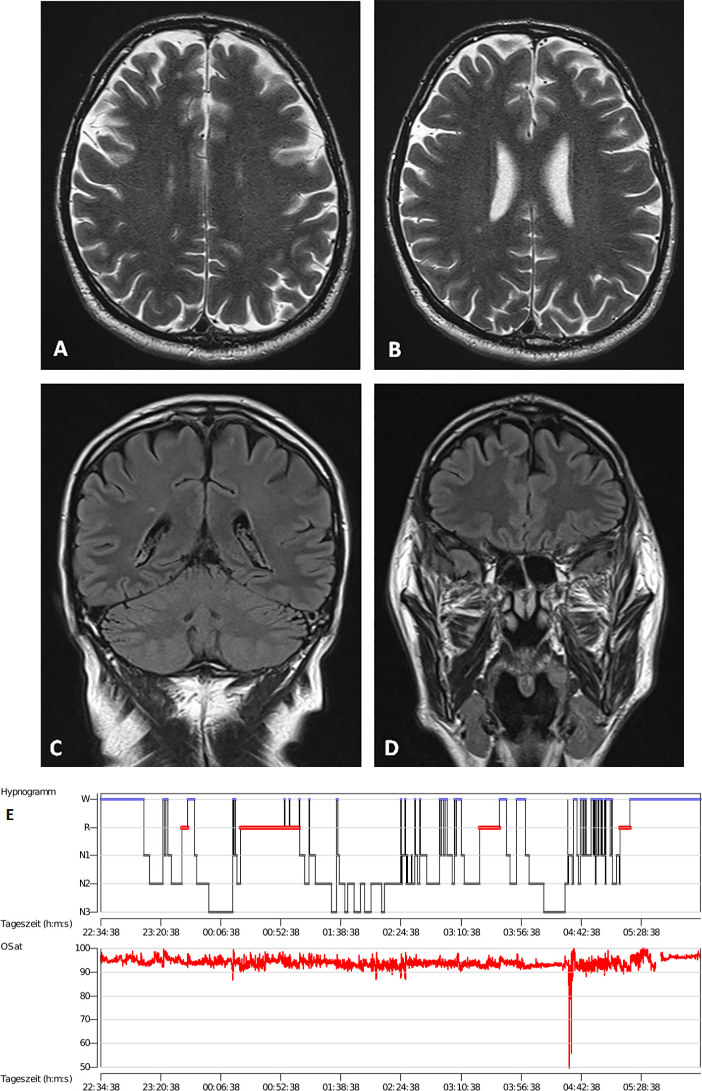 Frontiers | Figural Memory Impairment in Conjunction With