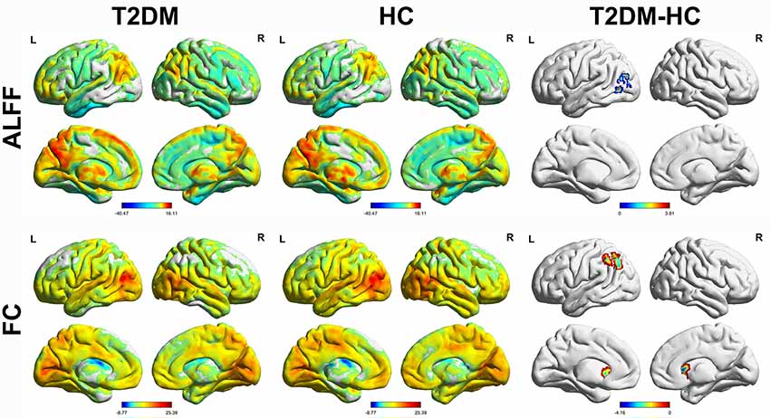 Frontiers  Abnormal brain spontaneous activity in major