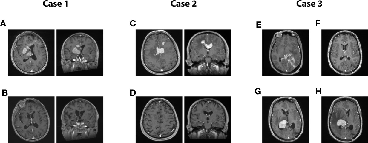 Frontiers | Management of Primary Central Nervous System Lymphoma Using ...