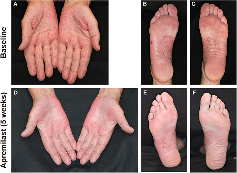 best biologic for palmoplantar pustulosis