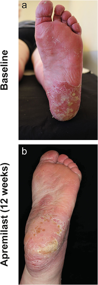palmoplantar psoriasis on feet