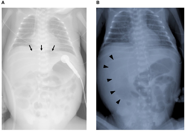 Frontiers Refractory Ileal Perforations In A Cytomegalovirus Infected Premature Neonate