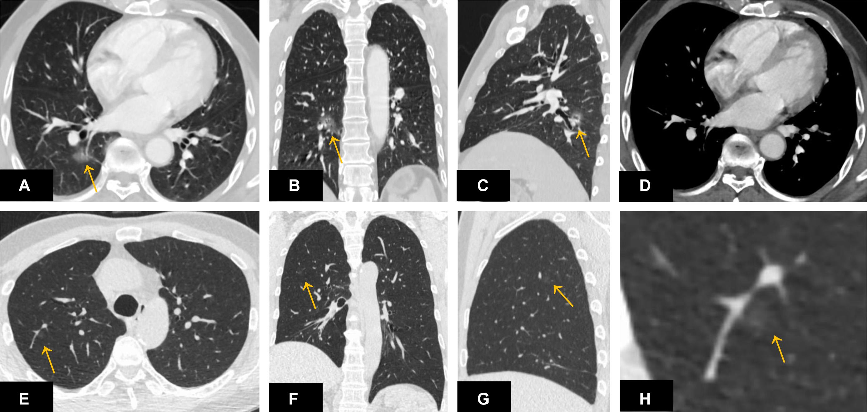 can lung cancer spread to thyroid