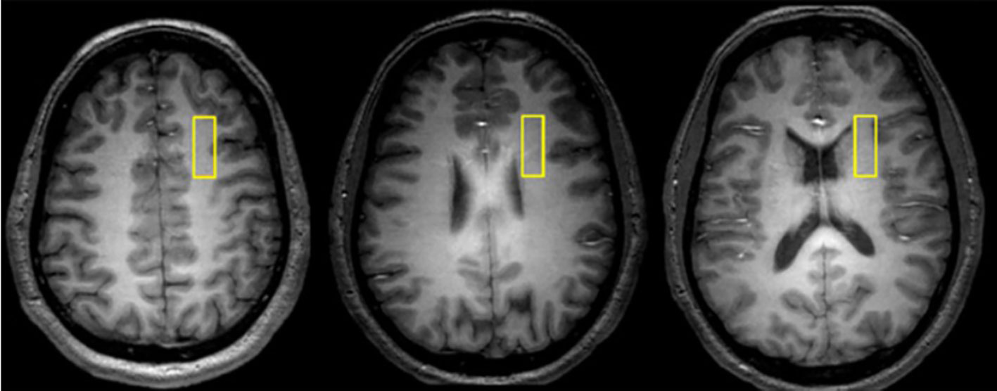 brain scan schizophrenia