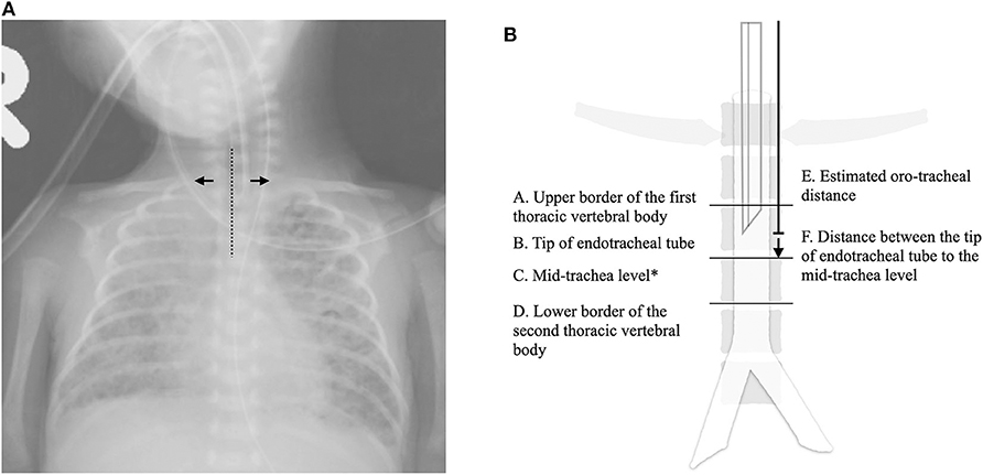 Frontiers - Comparisons and Refinements of Neonatal Oro-Tracheal Intubation Length Estimation ...