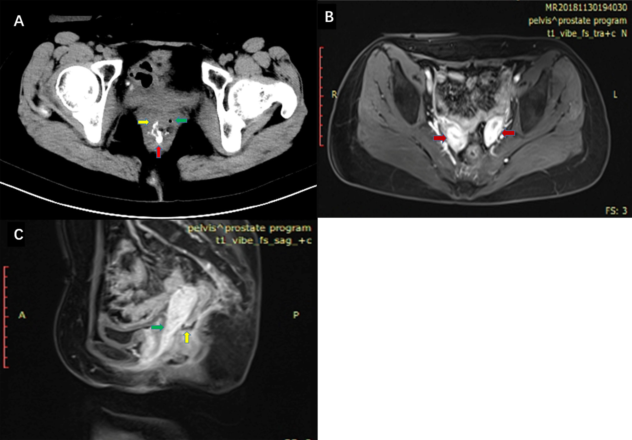 Rectal Advancement Flap Rectovaginal Fistula