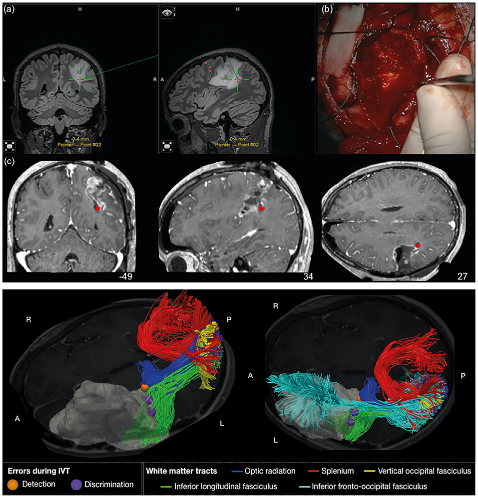 Perioperative Glycemia Management in Patients Undergoing Craniotomy for  Brain Tumor Resection: A Global Survey of Neuroanesthesiologists'  Perceptions and Practices - ScienceDirect