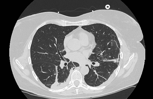 Frontiers | Chest Computed Tomography and Lung Ultrasound Findings COVID-19 Pneumonia: A Pocket Review Non-radiologists