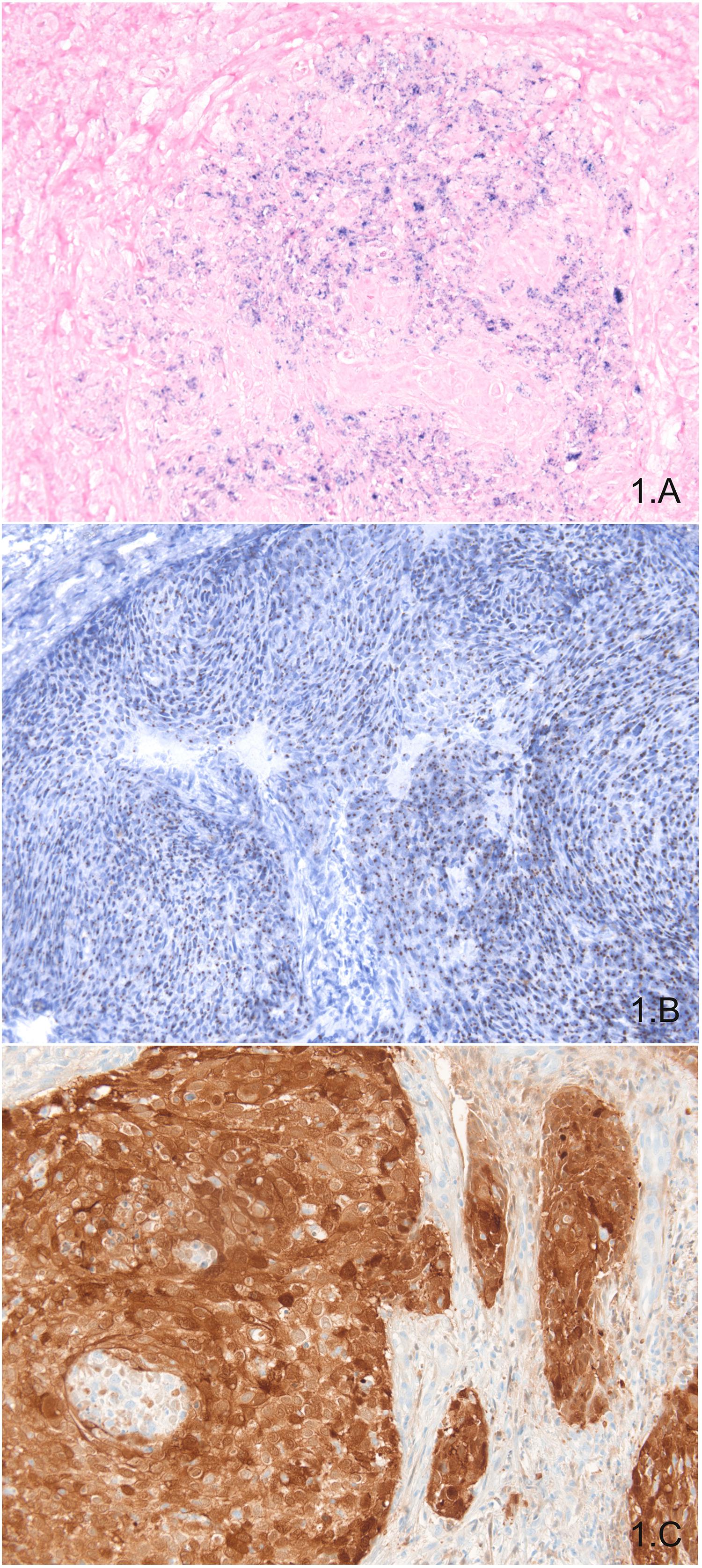 hpv és p16