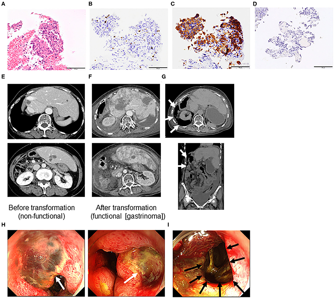 Neuroendocrine cancer end of life Neuroendocrine cancer end of life