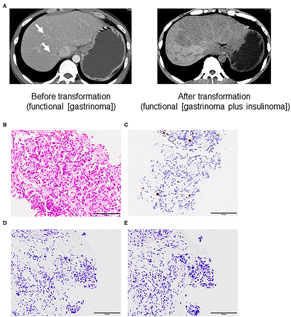 neuroendocrine cancer end of life