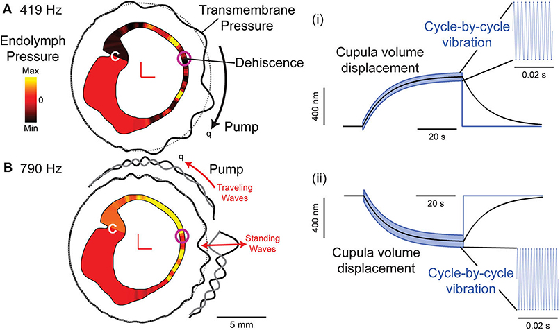 Frontiers  Audiovestibular Quantification in Rare Third Window