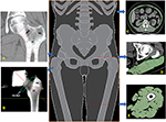 osirix lite segmentation osirix lite segmentation