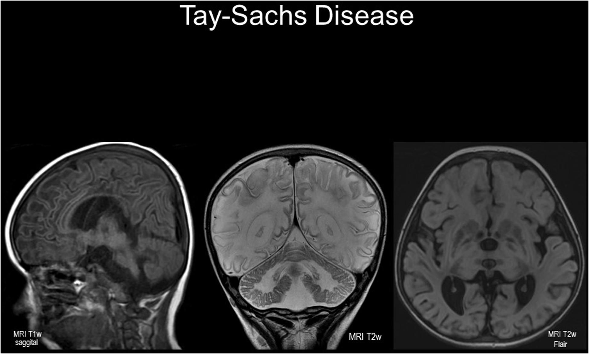 Frontiers  Lysosomal Diseases and Neuropsychiatry: Opportunities