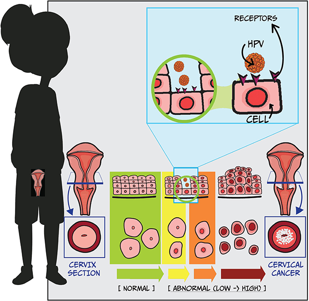 Figure 3 - From HPV infection to cervical cancer.