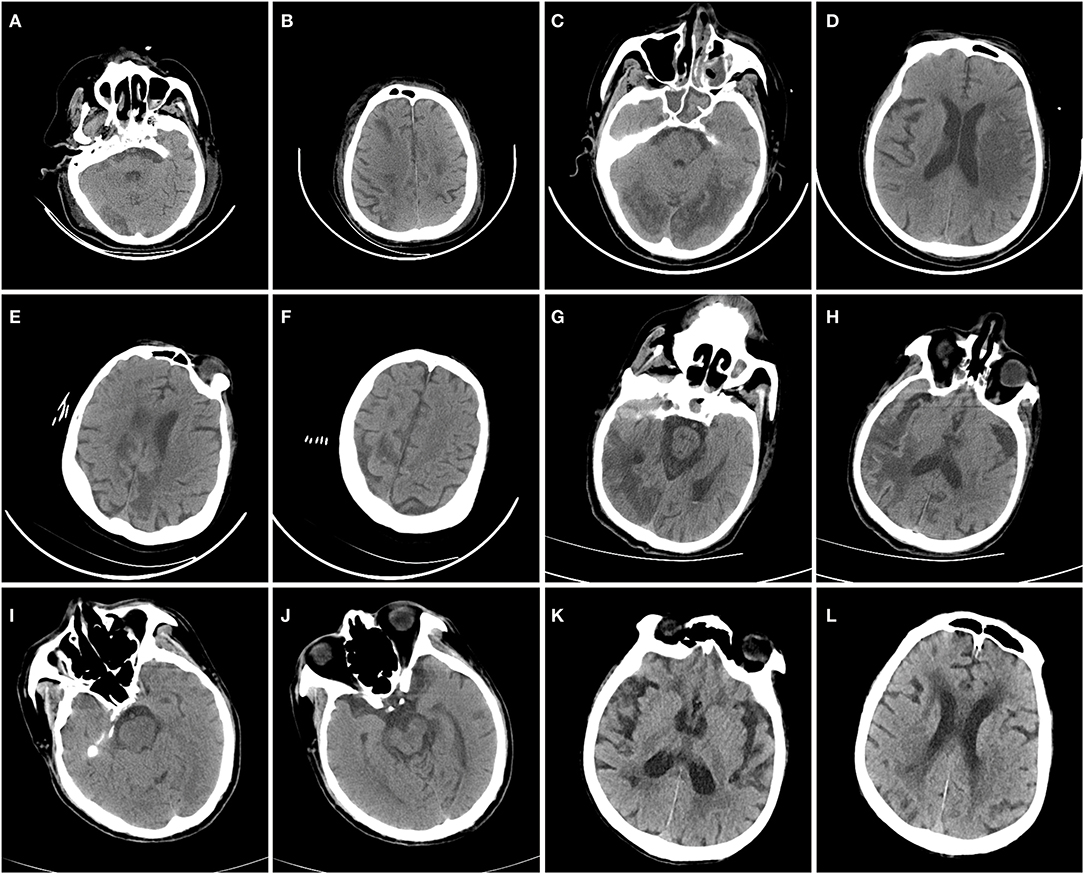 Frontiers | Neurological Manifestations in Critically Ill Patients With ...