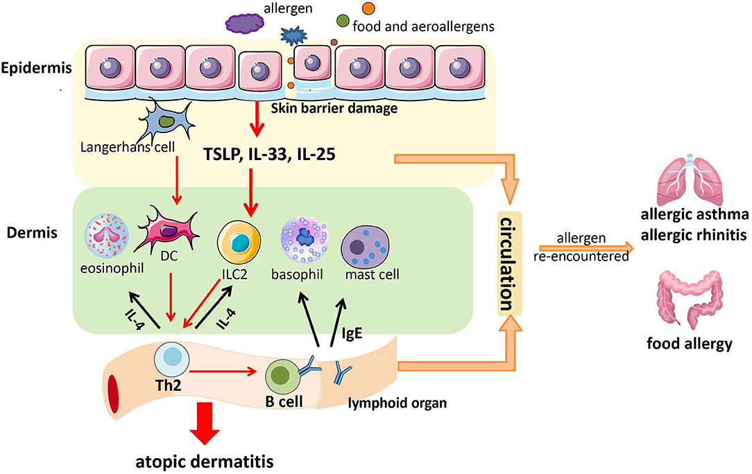 research progress in atopic march