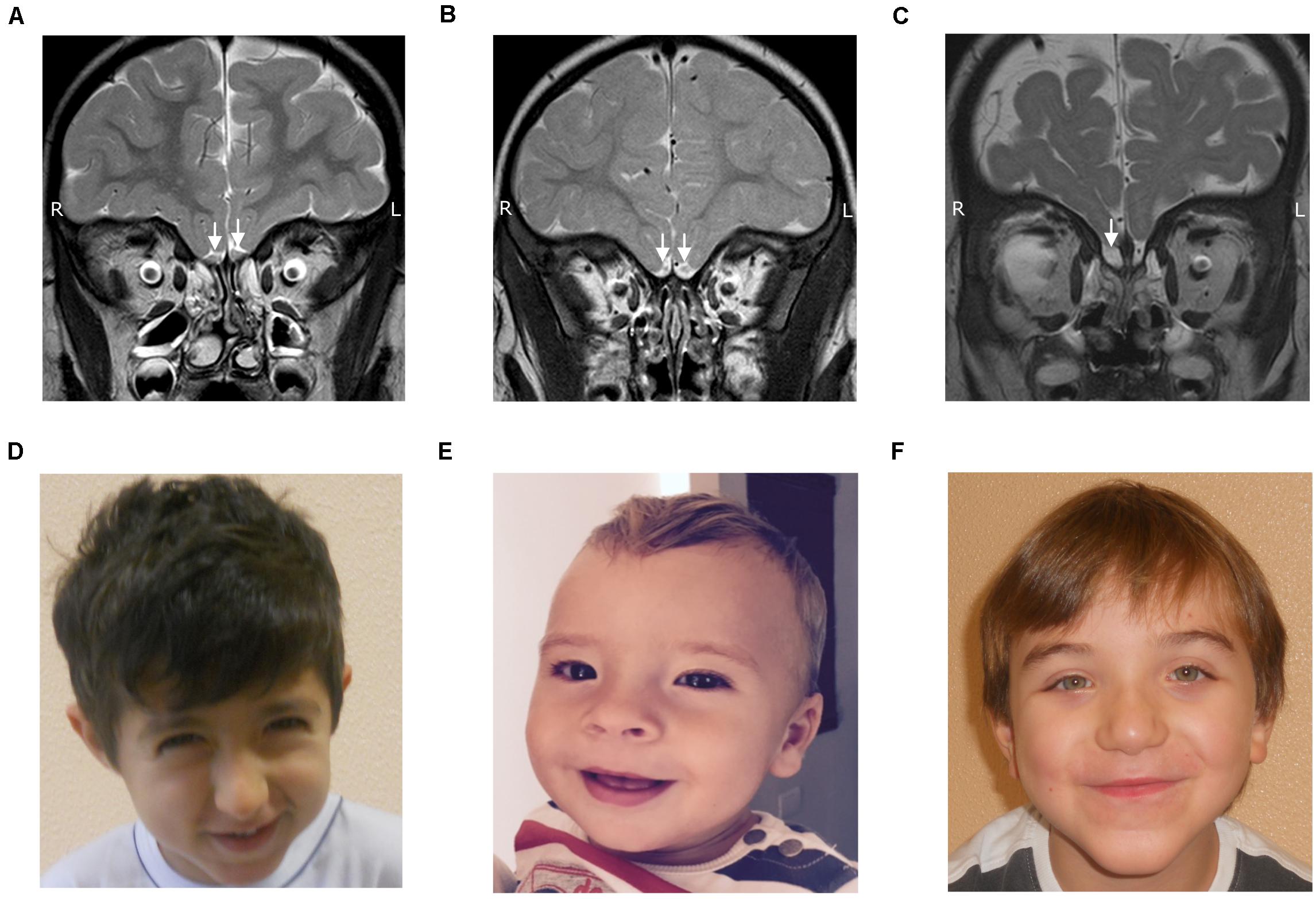 Rubinstein-Taybi syndrome 2 with cerebellar abnormality and neural