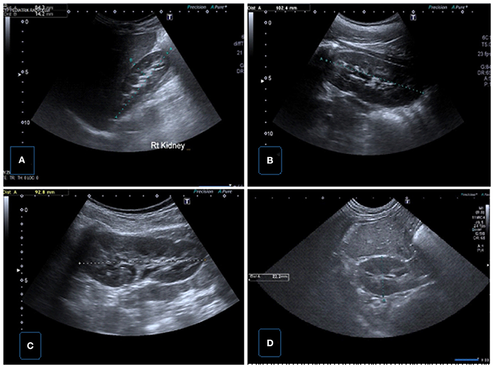 | Urinary Ultrasound and Other Imaging for Junction Type Hydronephrosis (UPJHN)