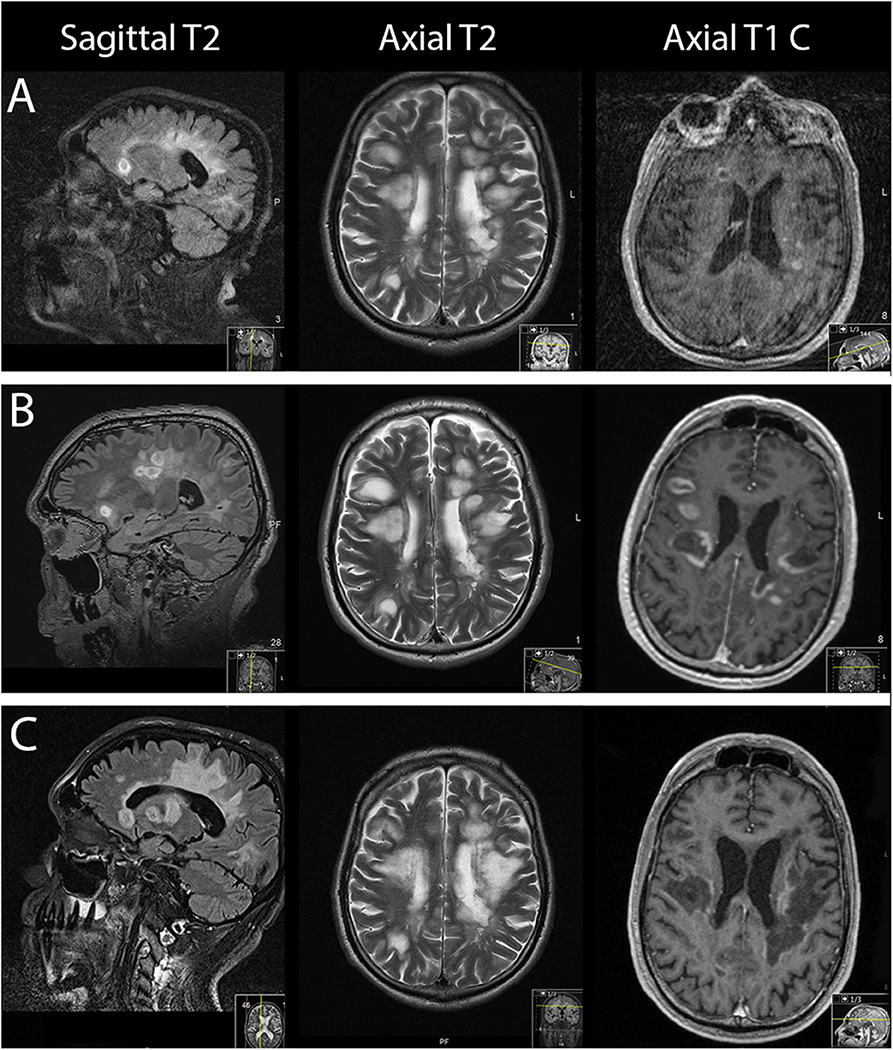 MS Brain Lesions and Their Effects