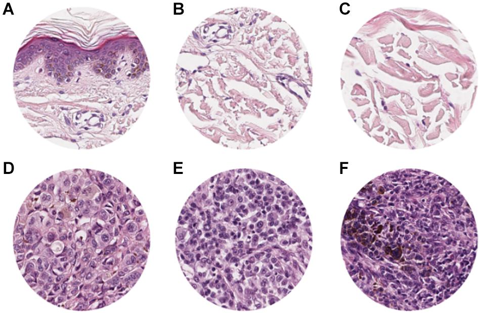 Invasive Melanoma Histology