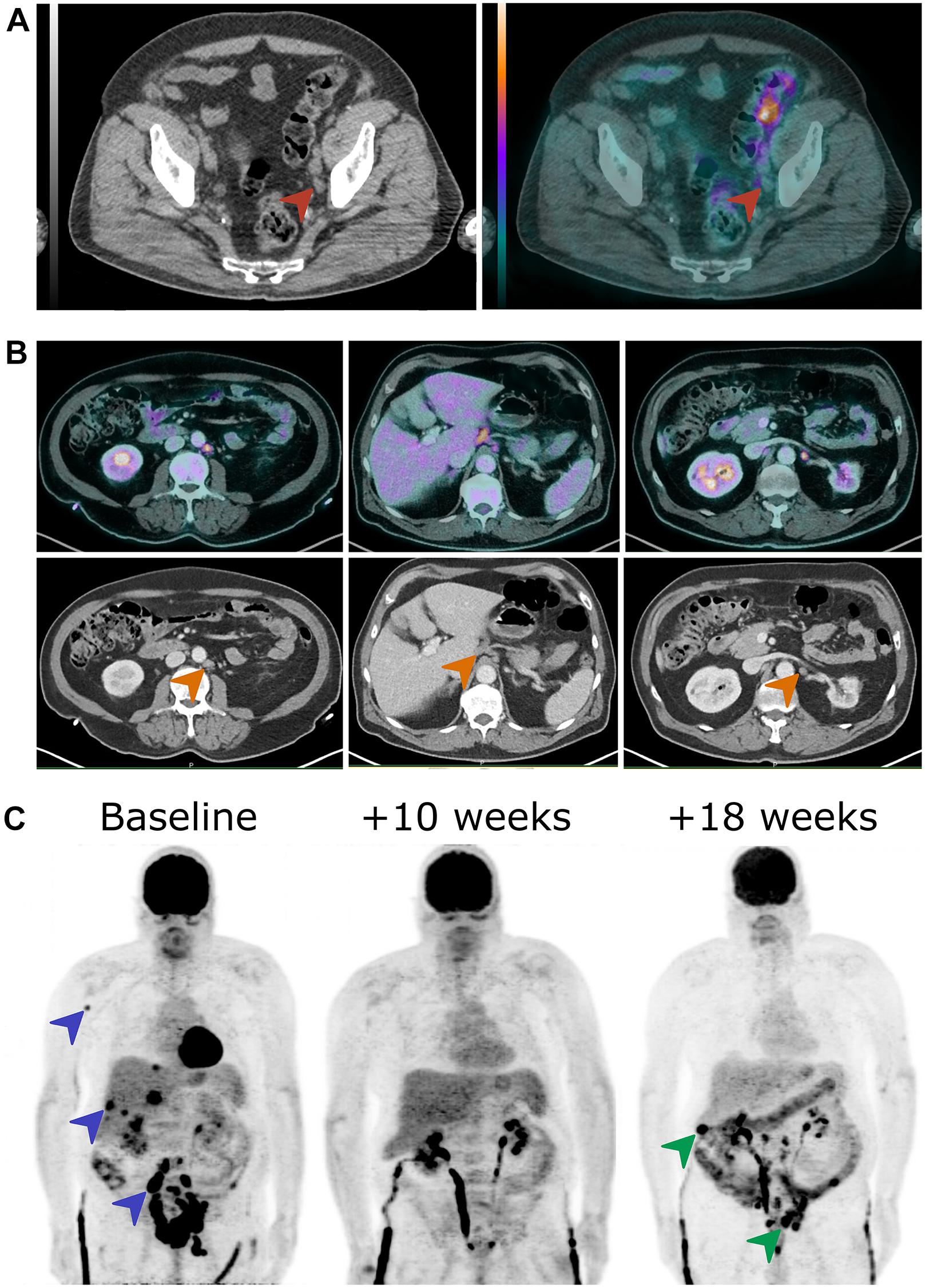 Frontiers | The Role of 18F-FDG PET/CT in Guiding Precision Medicine