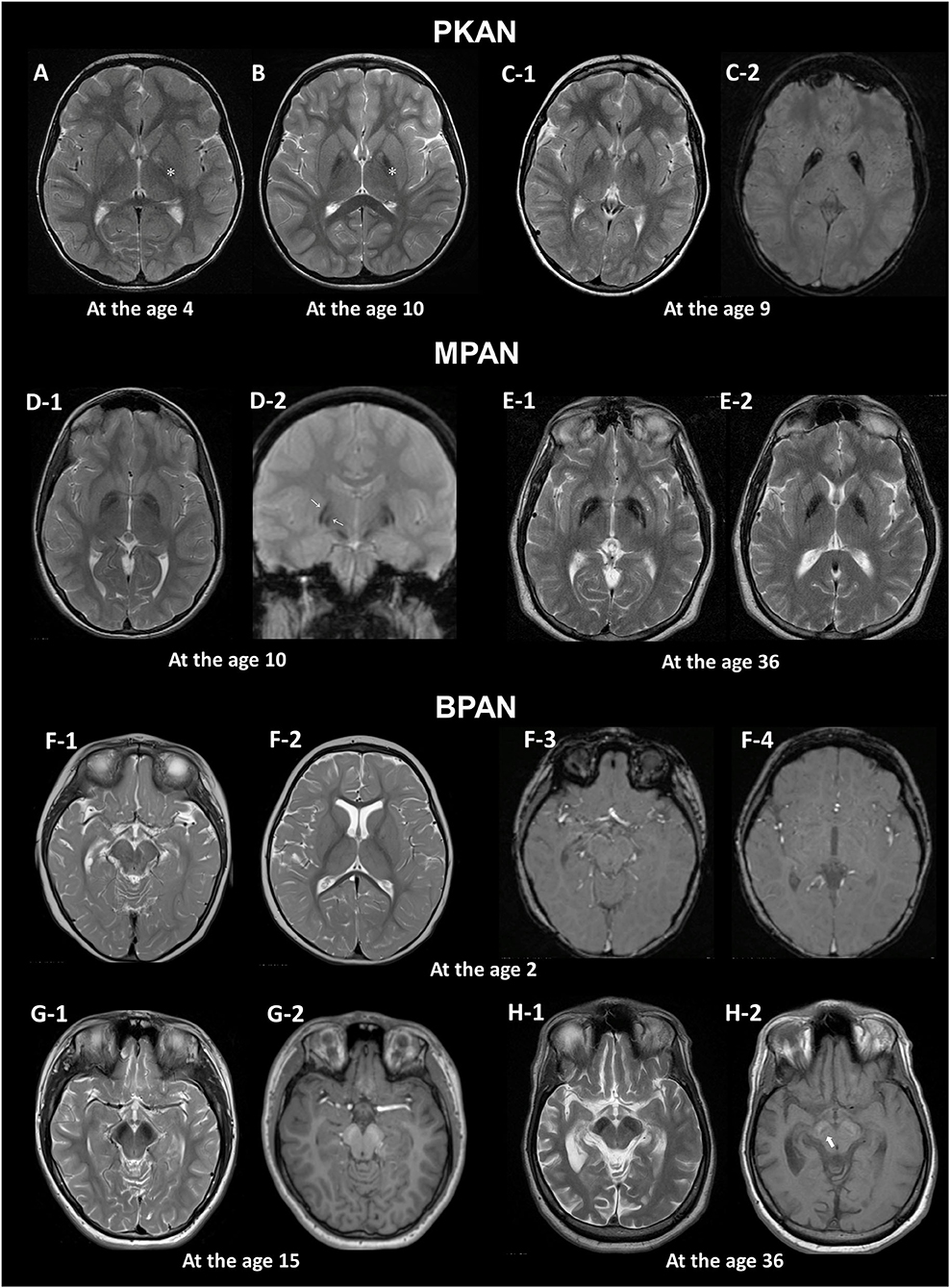 ms mri brain scan results