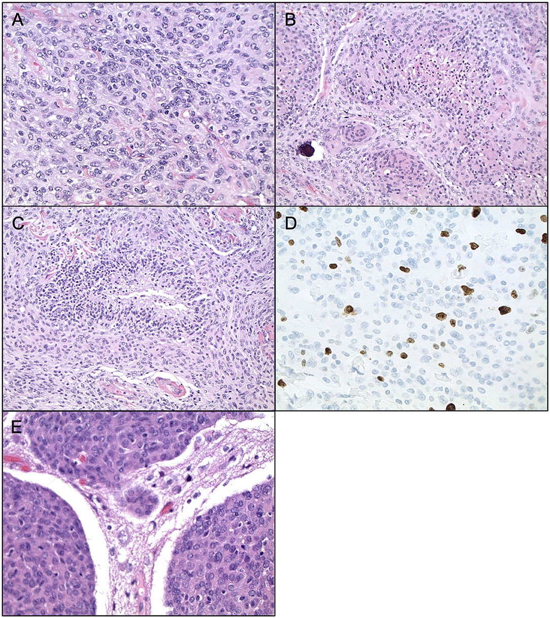 Faraha Karimaee Free Sex Videos - Frontiers | Review of Atypical and Anaplastic Meningiomas: Classification,  Molecular Biology, and Management