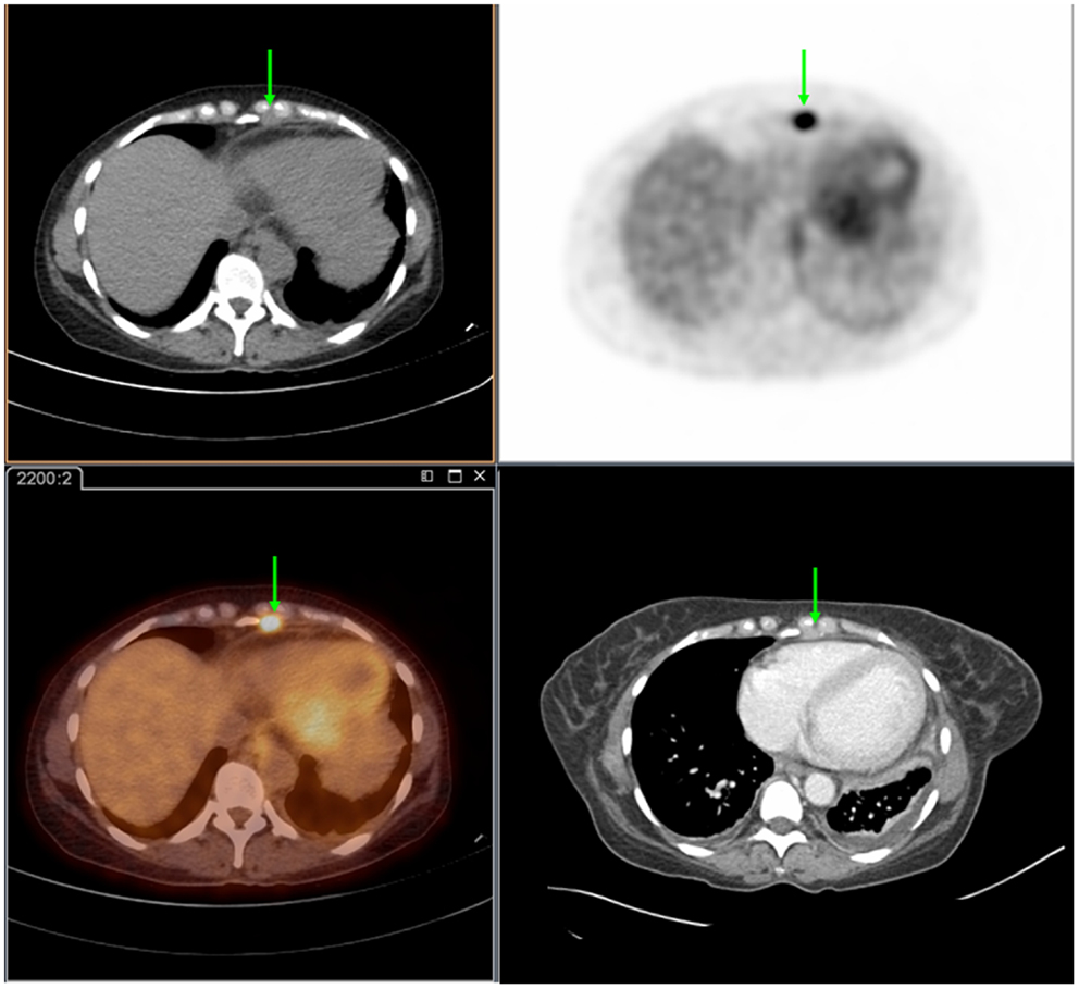 Lymph Node Ct Scan Contrast