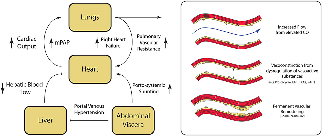 Frontiers Portopulmonary Hypertension From Bench to Bedside