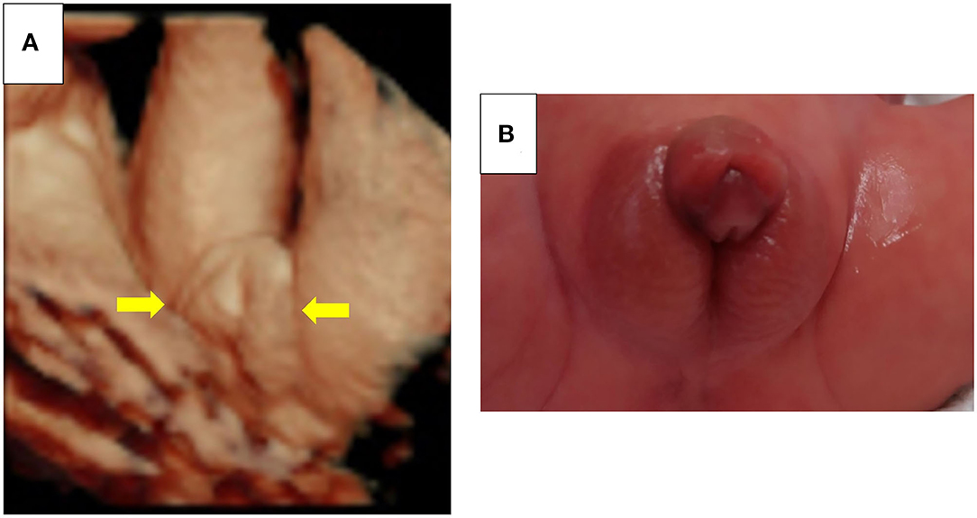 Pics Of Enlarged Clitorus