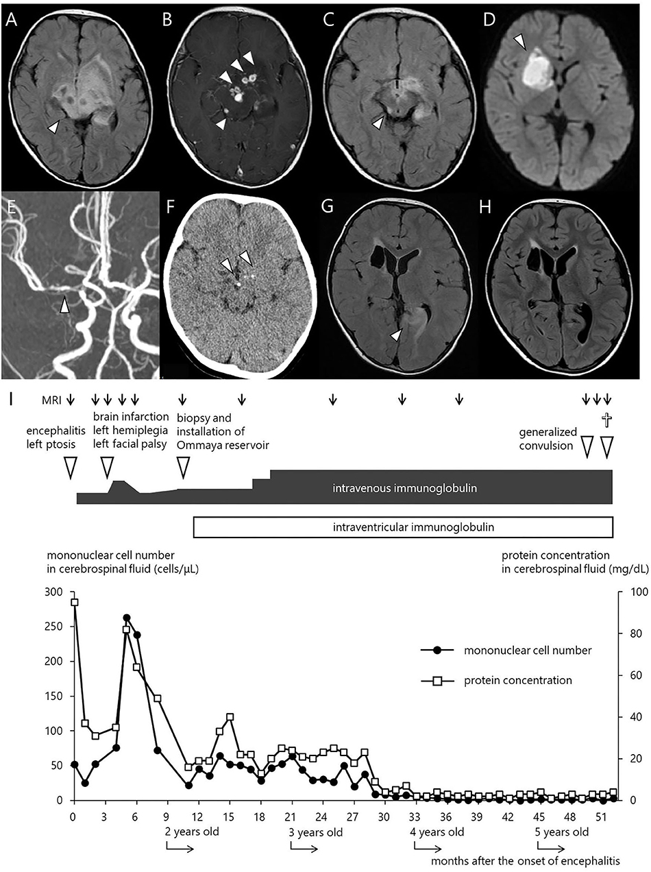 x linked agammaglobulinemia case study