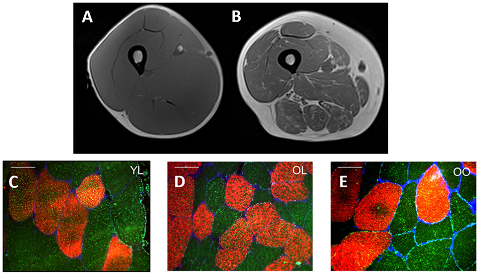 Frontiers | Exploring the Impact of Obesity on Skeletal Muscle