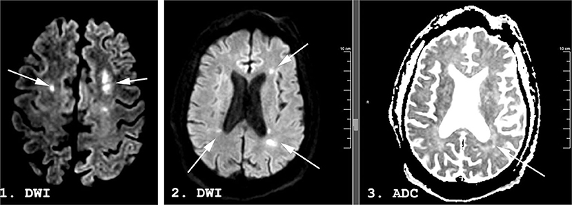 Frontiers | Case Series: Evidence of Borderzone Ischemia in Critically ...