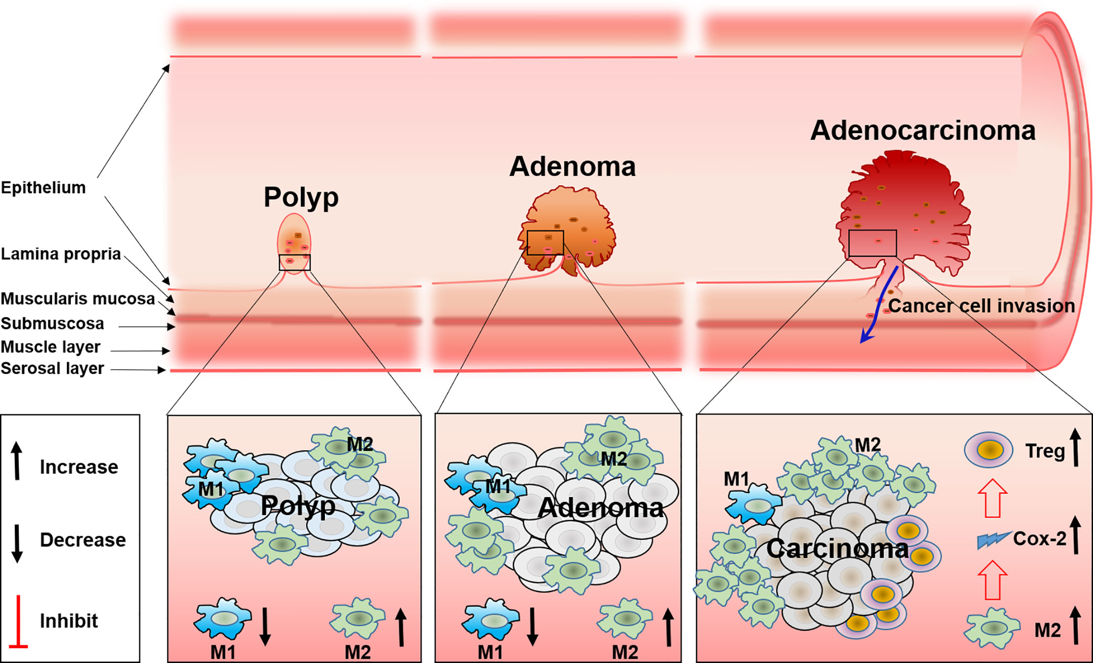 FAP patient with numerous adenomatous polyps in the colon