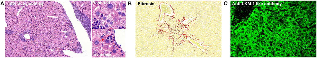 Frontiers | Regulatory T Cells in Autoimmune Hepatitis: Unveiling 