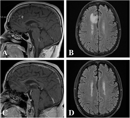 Frontiers | Response of Pembrolizumab Alone for Non-small Cell Lung ...