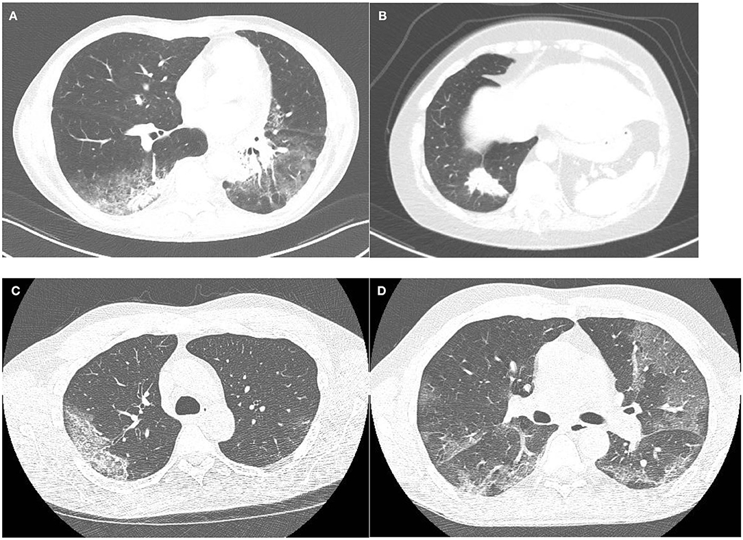 Frontiers | Differentiation of COVID-19 Pneumonitis and ICI Induced ...