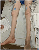 pain after emg pain after emg