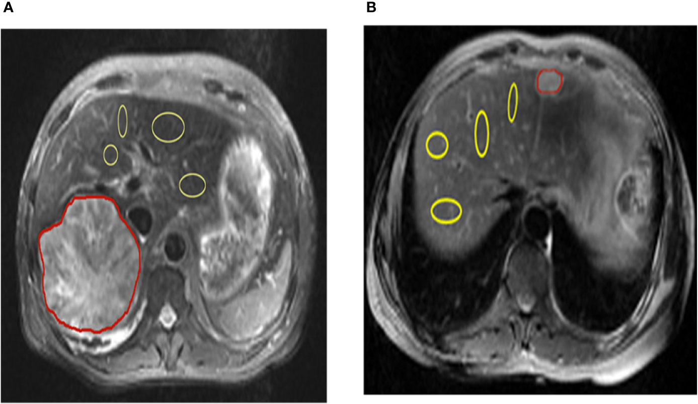 Frontiers | Noninvasive Detection of in Human Benign Malignant Liver Tumors Using CEST MRI