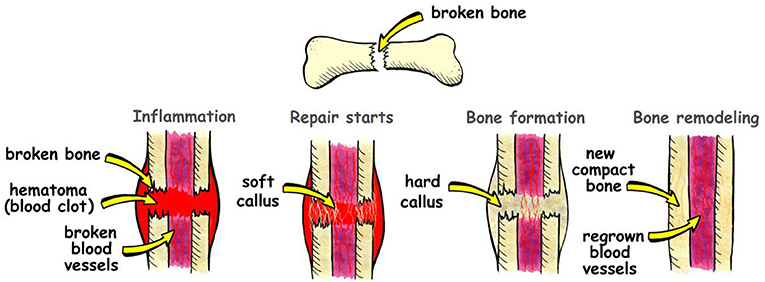 How To Repair Bones